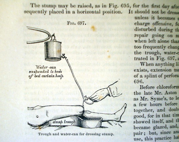 irrigation of amputated leg